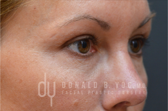 Upper Blepharoplasty after 3322724