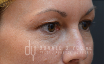Upper Blepharoplasty before 3322724