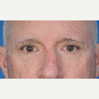 67 year old man treated with upper blepharoplasty after 3466719