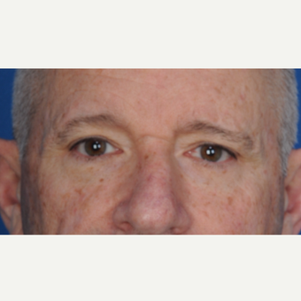67 year old man treated with upper blepharoplasty before 3466719