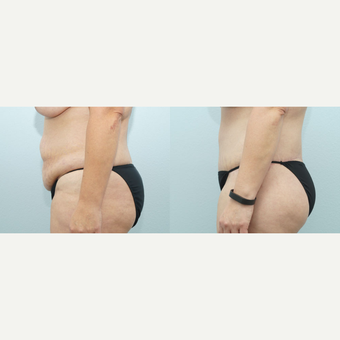 47 yr old Female - Body Lift and Breast Reduction after 3099810