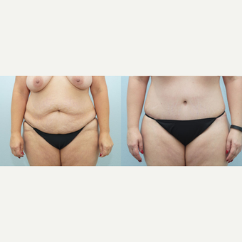 47 yr old Female - Body Lift and Breast Reduction before 3099810