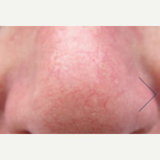 45-54 year old man treated with V Beam after 3141972