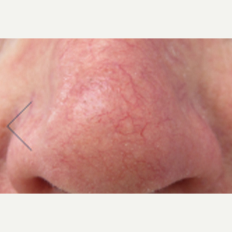45-54 year old man treated with V Beam before 3141972
