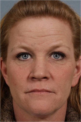 46 year old female with crows feet, loss of lip volume with smokers lines, heaviness of upper eye lids before 821871