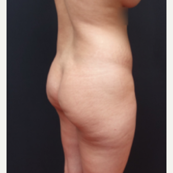25-34 year old woman treated with Butt Lift before 3267059