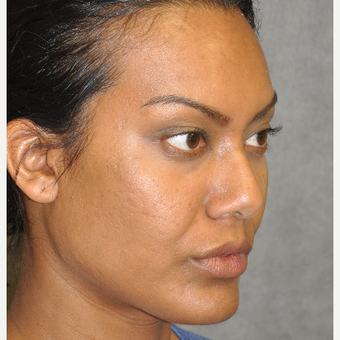 35-44 year old woman treated with Ultherapy after 3181730