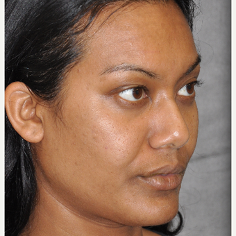 35-44 year old woman treated with Ultherapy before 3181730