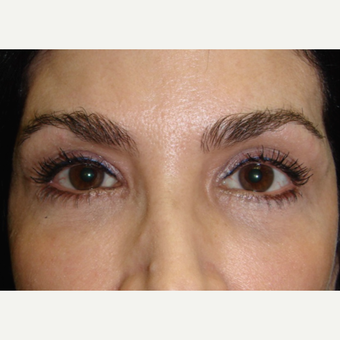45-54 year old woman treated with Restylane after 2060690