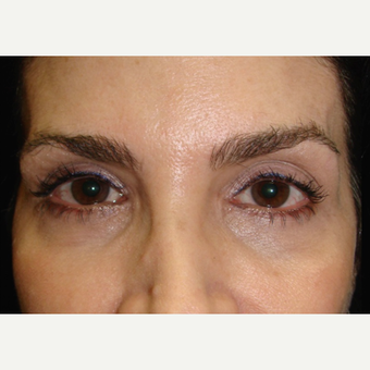 45-54 year old woman treated with Restylane before 2060690