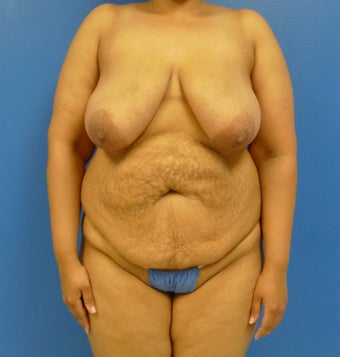 33 y.o. – female – breast augmentation with wise pattern lift, abdominoplasty; 420 cc Saline Implants before 1359572