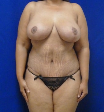 33 y.o. – female – breast augmentation with wise pattern lift, abdominoplasty; 420 cc Saline Implants after 1359572