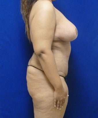 33 y.o. – female – breast augmentation with wise pattern lift, abdominoplasty; 420 cc Saline Implants 1359572