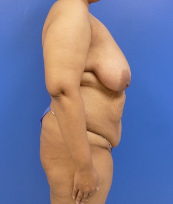 33 y.o. – female – breast augmentation with wise pattern lift, abdominoplasty; 420 cc Saline Implants 1359572