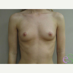 Breast Implants before 3373634