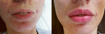 18-24 year old woman treated with Lip Augmentation for gummy smile before 3162234