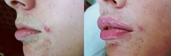 18-24 year old woman treated with Lip Augmentation for gummy smile after 3162234