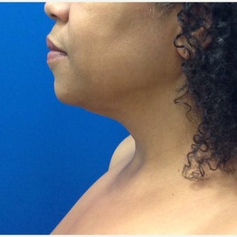 45-54 year old woman treated with Laser Liposuction after 2259842