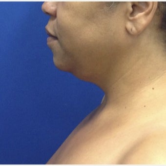 45-54 year old woman treated with Laser Liposuction before 2259842