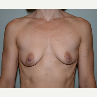 32 year old woman treated with Breast Augmentation before 3102916