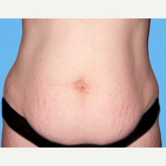 Tummy Tuck before 3810798