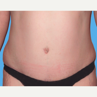 Tummy Tuck after 3810798