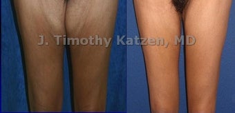 Thigh Lift after massive weight loss before 667179