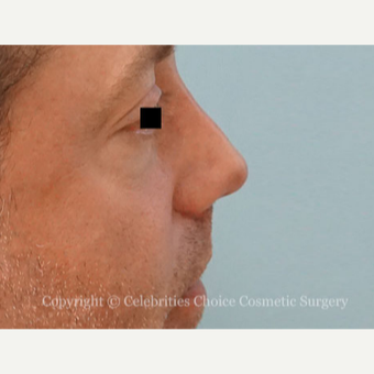35-44 year old man treated with Revision Rhinoplasty after 3198197