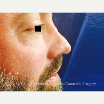 35-44 year old man treated with Revision Rhinoplasty before 3198197