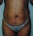 26 year old female patient before 934729
