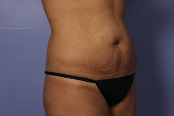 Tummy Tuck before 686063