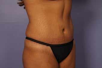Tummy Tuck after 686063