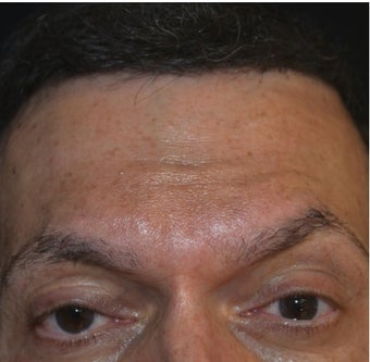 50 Year Old Male Treated for Forhead Lines after 1373418