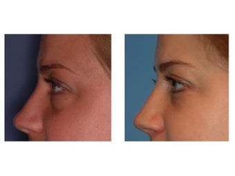 34 year old woman with thyroid eye disease treated for puffy lower lids after 911752