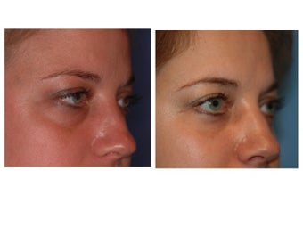 34 year old woman with thyroid eye disease treated for puffy lower lids before 911752