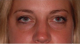 34 year old woman with thyroid eye disease treated for puffy lower lids 911752