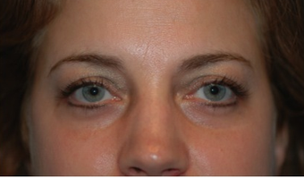 34 year old woman with thyroid eye disease treated for puffy lower lids 911752