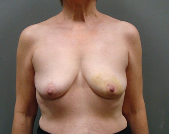 Breast Reconstruction before 1358634