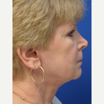 55-64 year old woman treated with "New Necklift" after 3480953