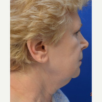 55-64 year old woman treated with "New Necklift" before 3480953