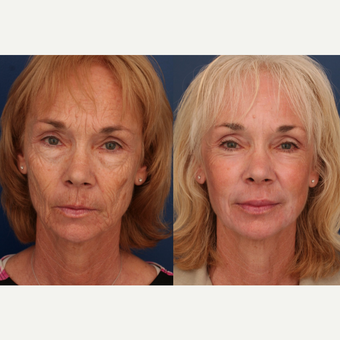 55-64 year old woman treated with CO2 Laser before 3705948