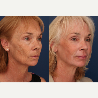 55-64 year old woman treated with CO2 Laser after 3705948
