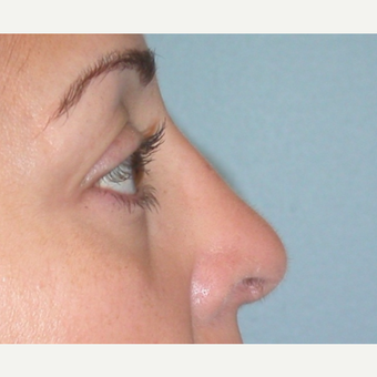 45-54 year old woman treated with Rhinoplasty after 3074896