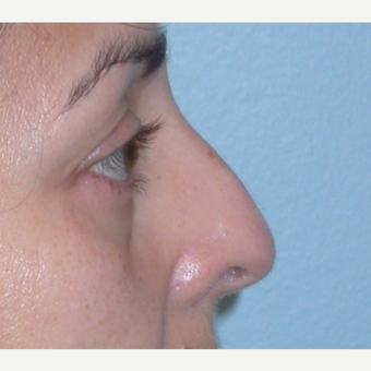 45-54 year old woman treated with Rhinoplasty before 3074896
