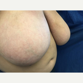25-34 year old woman treated with Breast Reduction before 3629370