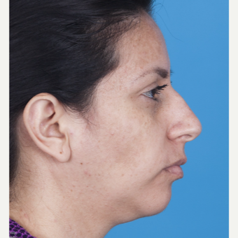 35-44 year old woman treated with Rhinoplasty before 3115224