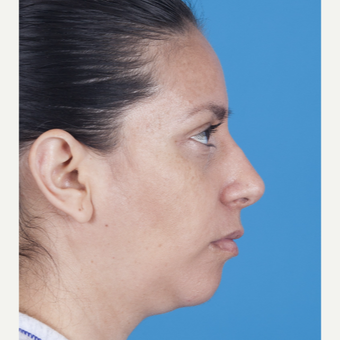 35-44 year old woman treated with Rhinoplasty after 3115224