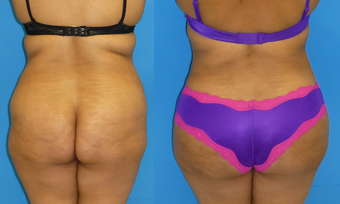 33 Year Old Female with Brazilian Butt Lift -BBL before 1140565