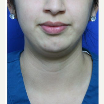 A young woman who is thin, but was bothered by her "double chin" was treated with Kybella. before 3736535