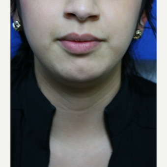 A young woman who is thin, but was bothered by her "double chin" was treated with Kybella. after 3736535